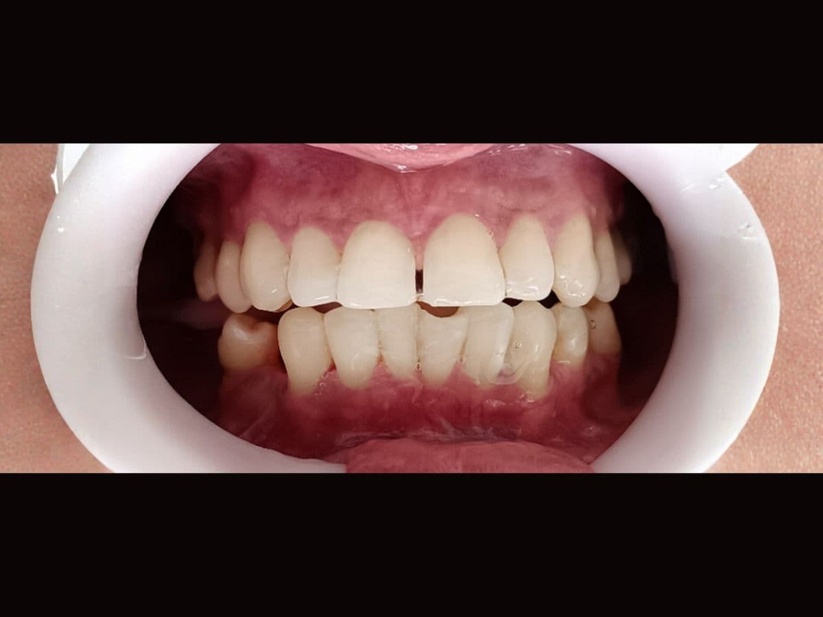 Limpieza Dental Profesional