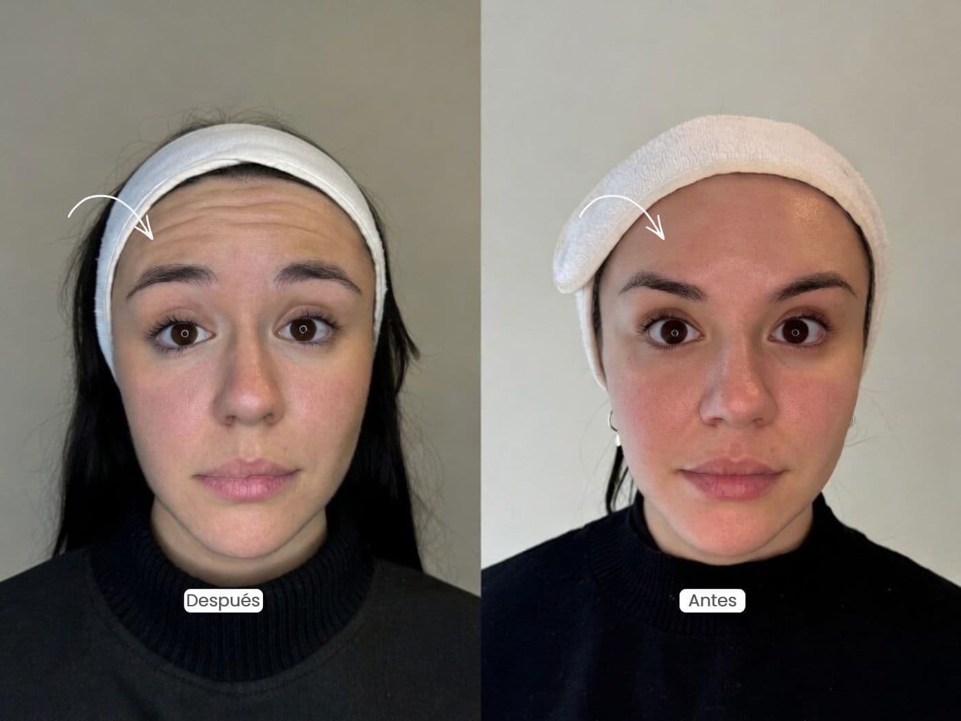 Baby Botox