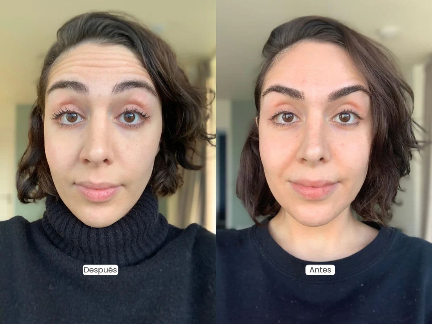 Botox Preventivo: ¿A qué edad empezar y cuáles son sus beneficios?