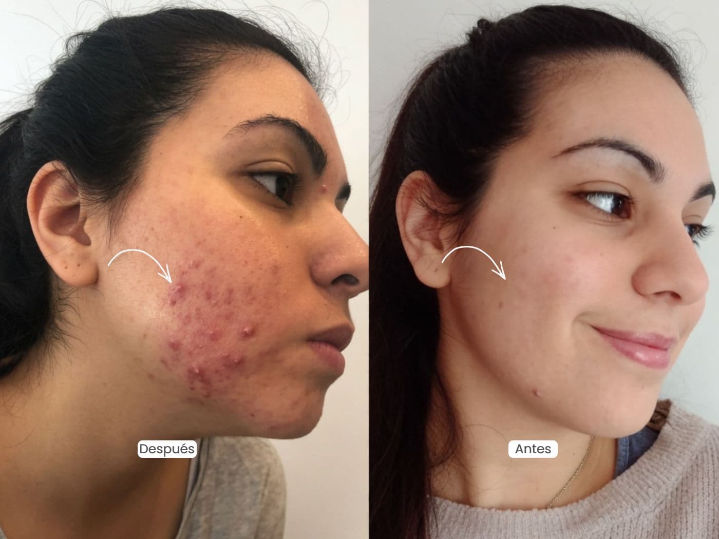 Peeling Facial