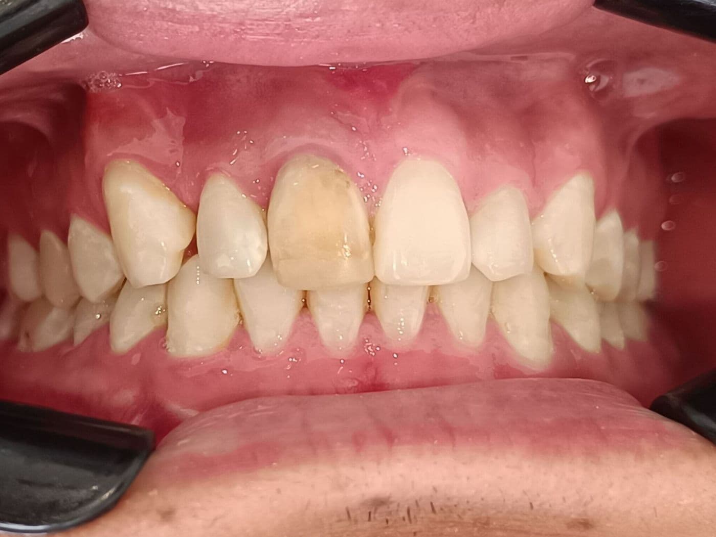 Blanqueamiento Interno (Endo-blanqueamiento)