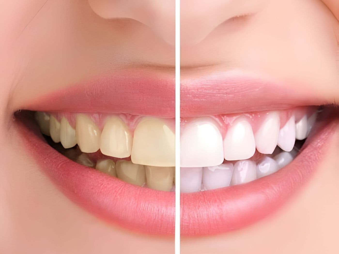 Blanqueamiento Dental: Mitos, Realidades y Resultados Reales