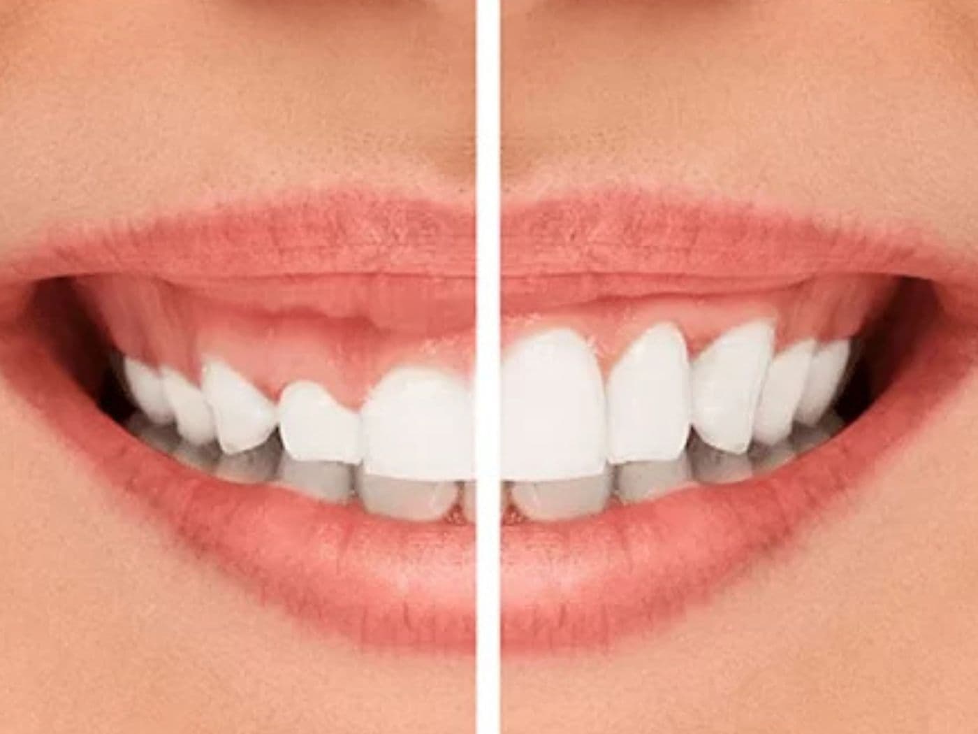 Gingivectomía