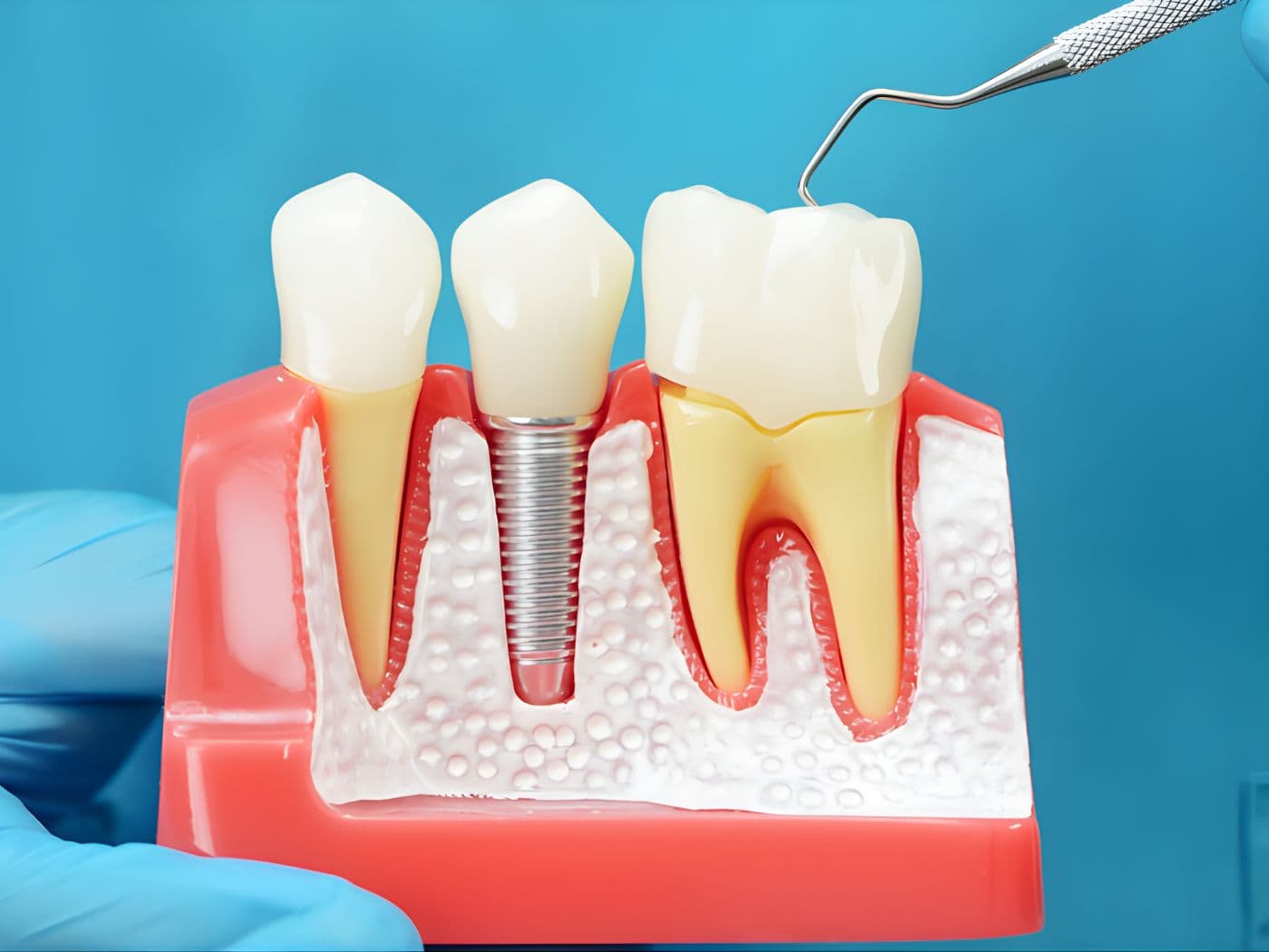 Cuidados Esenciales Post-Implante Dental: Guía Completa