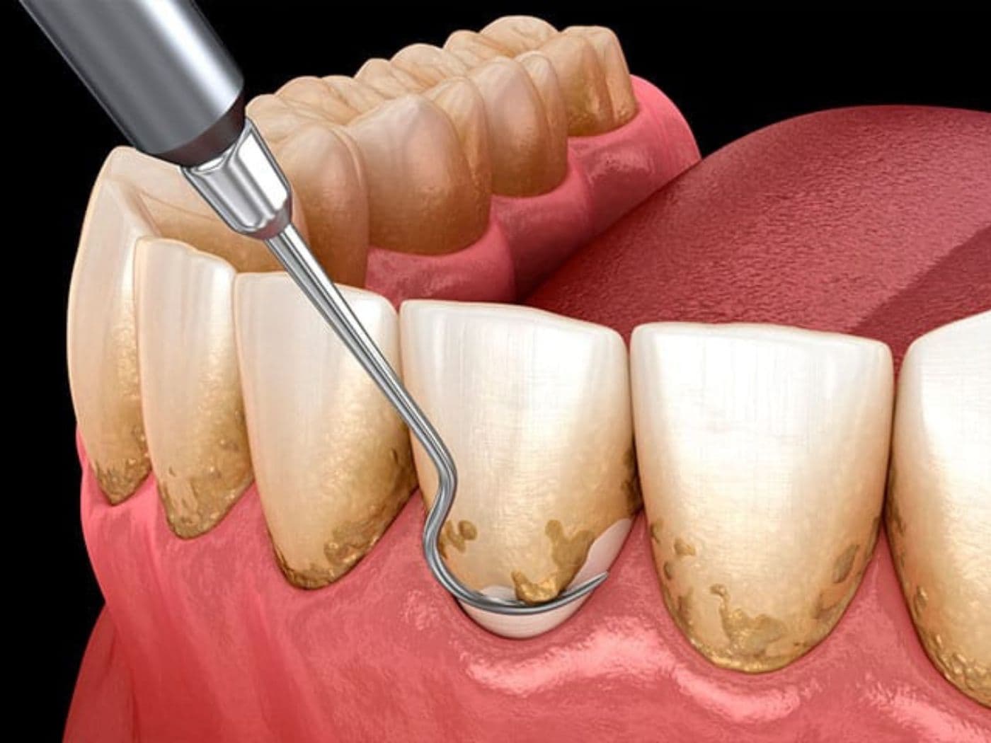 Periodoncia (Tratamiento de Encías)